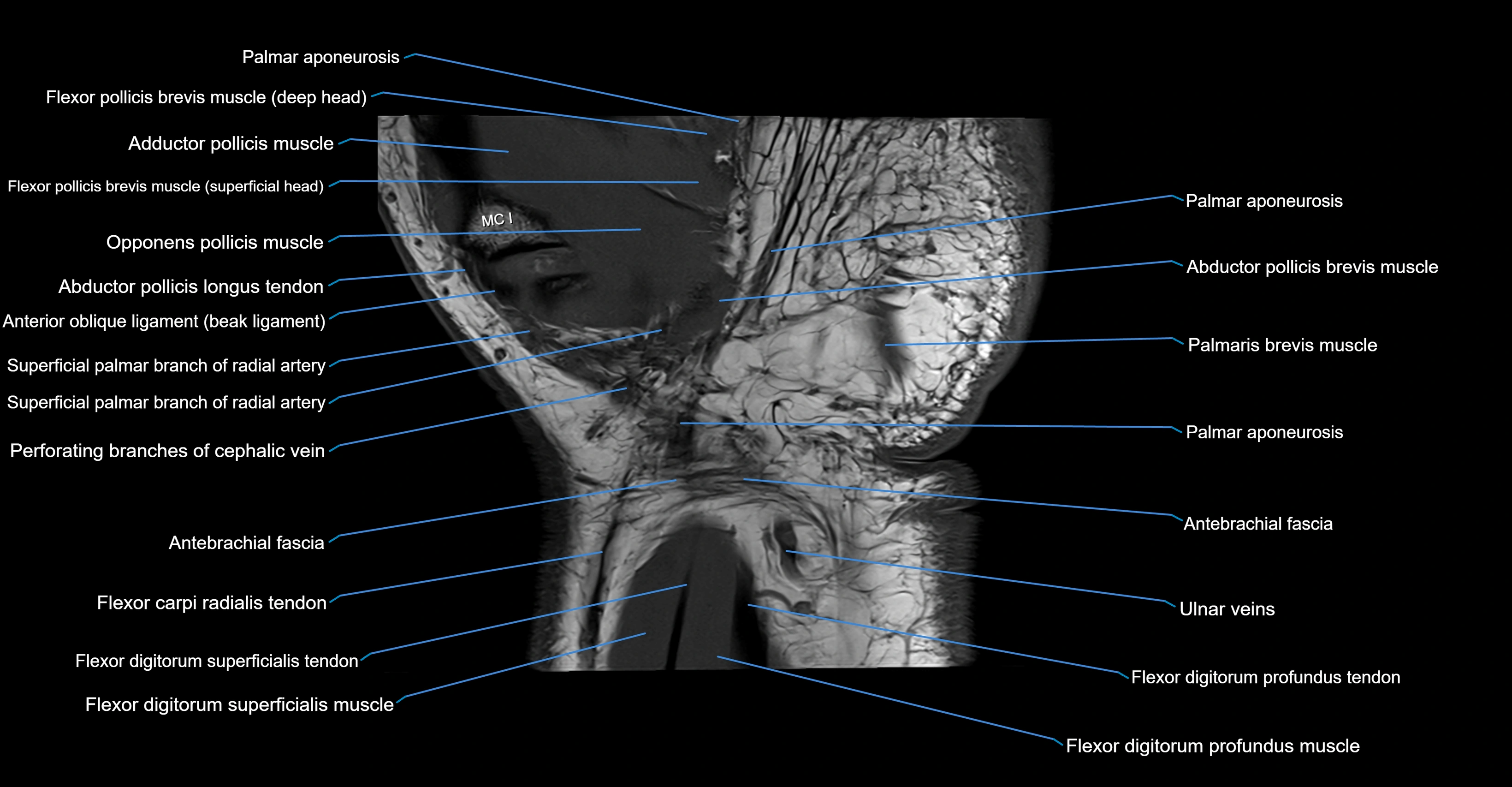 MRI wrist coronal cross sectional anatomy 3T  radiology  image-img-00001-00023.webp